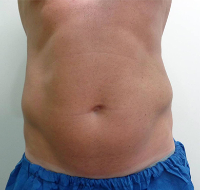 coolsculpting-after