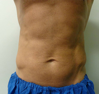 coolsculpting-before