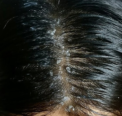 Dandruff treatment in Coimbatore