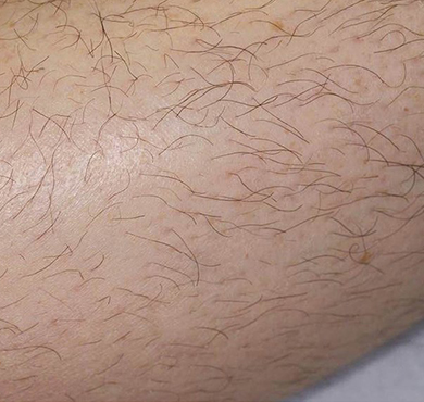 Laser Unwanted Hair Removal Signature18 Clinic Hair