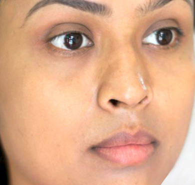 Skin-Lightening-Injections-after